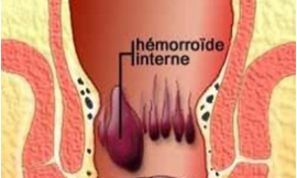 Les plantes anti-hémorroïdaires